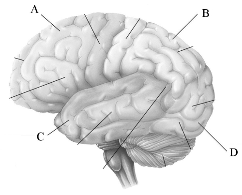 -Cortical deafness is a rare form of hearing loss where the patient is unable to hear sounds without any damage to the anatomy of the ear.What lobe is most affected in cortical deafness?