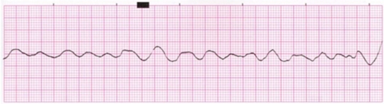 <strong>The nurse notes this rhythm on the patient's cardiac monitor.What is the nurse's priority intervention?  </strong> A)Check the patient's pulse. B)Administer oxygen. C)Call a code blue. D)Prepare to cardiovert the patient. <div style=padding-top: 35px> 