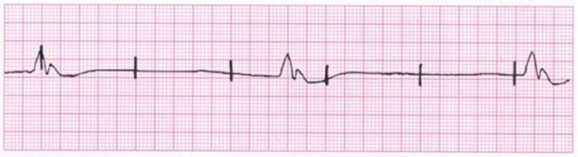 <strong>A patient with a temporary pacemaker has this cardiac rhythm.What nursing intervention is indicated?  </strong> A)Turn the impulse generator off,wait 30 seconds,and turn it back on. B)Call for a STAT portable chest x-ray. C)Check for a damaged lead wire. D)Decrease the pacemaker sensitivity. <div style=padding-top: 35px> 