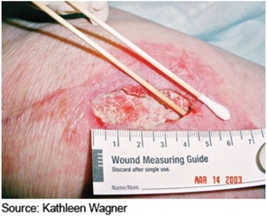 <strong>The nurse is assessing a wound using the technique shown in this picture.How would the nurse document this assessment? </strong> A)The wound is macerated. B)The wound is tunneled. C)The wound is deep. D)The wound is filled with exudate.