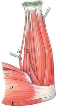 <strong>Identify the muscle labeled A in the following figure. </strong> A) palmaris longus B) flexor carpi ulnaris C) biceps brachii D) epitrochlearis E) triceps brachii