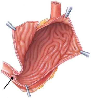 <strong>Identify the structure at the tip of the arrow in the following figure. </strong> A) pyloric sphincter B) ileocecal sphincter C) lower esophageal sphincter D) anal sphincter