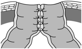 Identify the faecal diversion pictured below:  <div style=padding-top: 35px> 