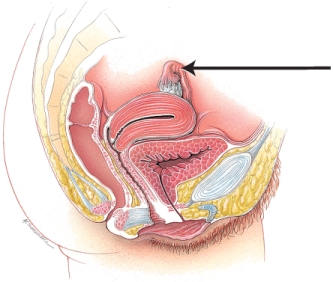 <strong>In this image of the female reproductive system, the line points to the </strong> A) ovary B) fallopian tube C) uterus D) pubic symphysis E) clitoris