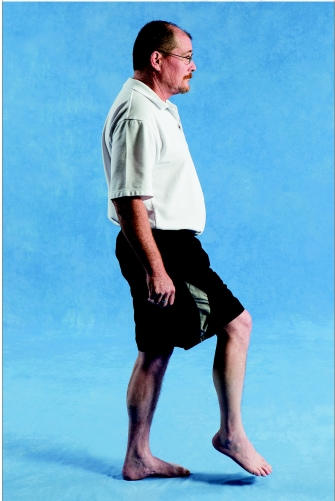 <strong> Weakness in which of the following muscles is MOST LIKELY to contribute to the atypical gait pattern shown in the image?</strong> A)Tibialis posterior B)Gluteus maximus C)Tibialis anterior D)Rectus femoris