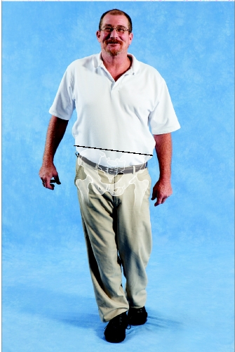<strong> Weakness in which of the following muscles is MOST LIKELY to produce the atypical gait shown in the image?</strong> A)Right hip abductors B)Left hip abductors C)Right hip adductors D)Left hip adductors