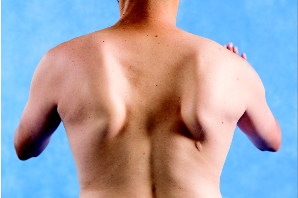 <strong> As shown in the image, what scapular muscle(s) is(are) most likely weak?</strong> A)Rhomboids B)Serratus anterior C)Latissimus dorsi D)Lower trapezius