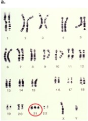 <strong>Figure 10-5   Which genetic condition is revealed in the karyotype display in Figure 10-5?</strong> A) cri-du-chat B) triple-X syndrome C) Turner syndrome D) Down syndrome <div style=padding-top: 35px> 