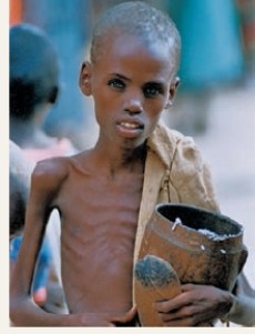 <strong>The child in the photo below is suffering from ___. </strong> A)lack of iodine in the diet B)anorexia nervosa C)Kwashiorkor D)Marasmus E)overnutrition