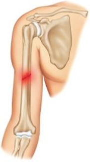 <strong>The fracture pictured here is a(n) ____. </strong> A) greenstick fracture B) comminuted fracture C) closed fracture D) incomplete fracture E) open fracture