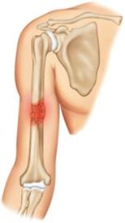 <strong>Which of the following is pictured here? </strong> A) Greenstick fracture B) Comminuted fracture C) Closed fracture D) Incomplete fracture E) Open fracture