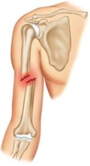 <strong>What type of fracture is pictured here? </strong> A) Greenstick fracture B) Comminuted fracture C) Open fracture D) Complete fracture E) Incomplete fracture