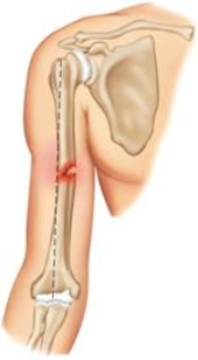 <strong>The fracture pictured here, which occurs most often in children, is a(n) ____. </strong> A) greenstick fracture B) comminuted fracture C) open fracture D) complete fracture E) dislocation