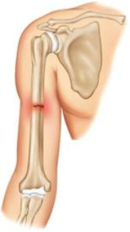 <strong>Which of the following is this fracture? </strong> A) Greenstick fracture B) Complete fracture C) Comminuted fracture D) Open fracture E) Incomplete fracture