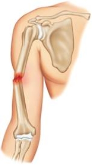 <strong>Which type of fracture is pictured here? </strong> A) Greenstick fracture B) Comminuted fracture C) Open fracture D) Closed fracture E) Dislocation