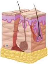 <strong>What type of wound is pictured here? </strong> A) Laceration B) Puncture C) Abrasion D) Contusion E) Incision