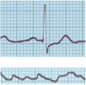 <strong>In the figure shown here, the top ECG shown is normal. What condition does the bottom ECG indicate? </strong> A) ventricular fibrillation B) a heart murmur C) hypertension D) stroke E) angina pectoris