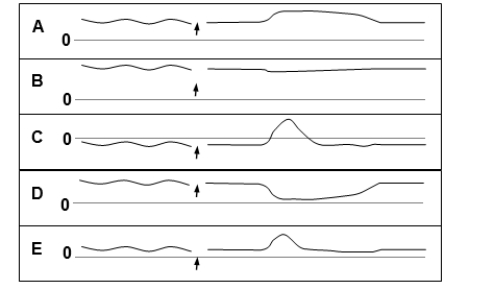 Which one of the following manometric recordings illustrates normal function of the esophagus at mid-thoracic level before and after swallowing (arrow)? The dashed lines represent a pressure of 0 mm Hg.