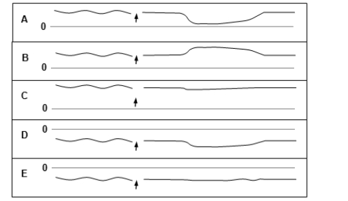 A 39-year-old man has from chest pain when he eats, especially meat. He also belches excessively and has heartburn. His wife complains about his bad breath. The radiograph shows a dilated esophagus, and achalasia is suspected. Esophageal manometry confirms the diagnosis. Which one of the pressure tracings given below was taken at the lower esophageal sphincter of this patient before and after swallowing (arrow)? The dashed line represents a pressure of 0 mm Hg.