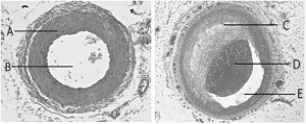 <strong> Use the figure above to answer the following questions. The anatomical structure identified with the letter C in the figure above is</strong> A) the arterial wall. B) the lumen. C) atherosclerotic plaque. D) the capillary wall. E) none of these.