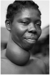<strong> The woman in the above photograph has been afflicted by</strong> A) low iodine in the diet. B) hypothyroidism. C) vitamin D deficiency. D) testosterone excess. E) progesterone deficiency.