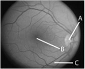 <strong> The letter B in the above figure represents</strong> A) cortex. B) cornea. C) fovea. D) blood vessels. E) optic nerve.