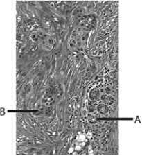 <strong>  Which letter in the above figure represents breast cancer?</strong> A) A B) B C) both A and B D) neither A or B E) this is prostate tissue <div style=padding-top: 35px> 