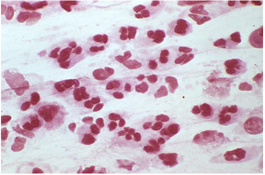 <strong>Review the Gram stain image of a cerebrospinal fluid. Based on the results, you should </strong> A) look at a drop of the specimen under a darkfield microscope. B) prepare a new slide and perform a Kinyoun stain. C) prepare a new slide and perform an acridine orange stain. D) report the slide as no organisms seen.