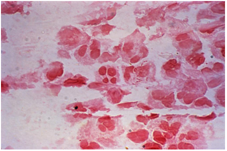 <strong>Review the Gram stained urine image provided. Which organism listed best correlates with this Gram stain reaction? </strong> A) Beta-hemolytic, catalase negative, and PYR positive B) Beta-hemolytic, catalase and coagulase positive C) Gamma-hemolytic, swarmer, oxidase, and spot indole negative D) Alpha-hemolytic, catalase negative, and bile soluble