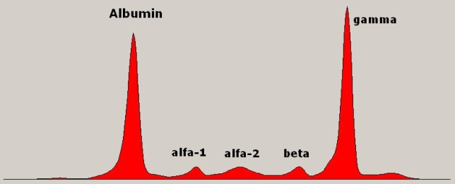 <strong>Using the image provided, which of following diseases is represented in the results of this zone electrophoresis test? Source: Steven Fruitsmaak</strong> A) Syphilis B) Rheumatoid arthritis C) HIV D) Multiple myeloma