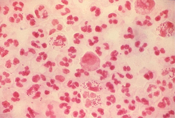 <strong>A 17-year-old female presents with burning on urination. The physician sends the laboratory a voided urine sample and swab of the urethra of this patient. The urine and swab are plated and a direct Gram stain of the urethral swab is performed. The image provided demonstrates the results of the direct Gram stain of the urethra. Source: CDC and Joe Miller This Gram stain considered diagnostic for ___________.</strong> A) a urinary tract infection and the urine culture is not needed. B) trichomoniasis and neither the urine nor urethral culture is needed. C) gonorrhea and the urethral culture is not needed. D) unable to diagnose from the Gram stain.