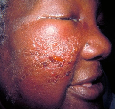 <strong>A 37-year-old female diabetic presented as seen in the image provided. The physician described the affected facial area as shiny, raised, hardened, and tender with a distinct margin. Which of the following organisms is most likely the causative agent? Source: CDC/Dr. Thomas F. Sellers/Emory University</strong> A) Catalase-negative, bacitracin-susceptible, gram-positive coccus B) Catalase-positive, coagulase-positive, gram-positive coccus C) Oxidase-positive, gram-negative rod that produces a blue-green pigment and a grape-like odor D) Fungus