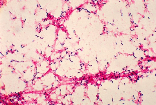<strong>A specimen collected via tympanocentesis is received in a capped syringe on evening shift at 4:00 pm. The specimen was placed in the refrigerator until processed at 10:00 pm. The direct Gram stain is provided. Source: CDC/Dr. Mike Miller At 24 and 48 hours, the sheep blood, chocolate, and MacConkey agars are all negative for growth. Which of the following best explains the discrepant results?</strong> A) The organism is fastidious. B) The patient is taking antibiotics. C) The organism autolyzed. D) The organism is an anaerobe.