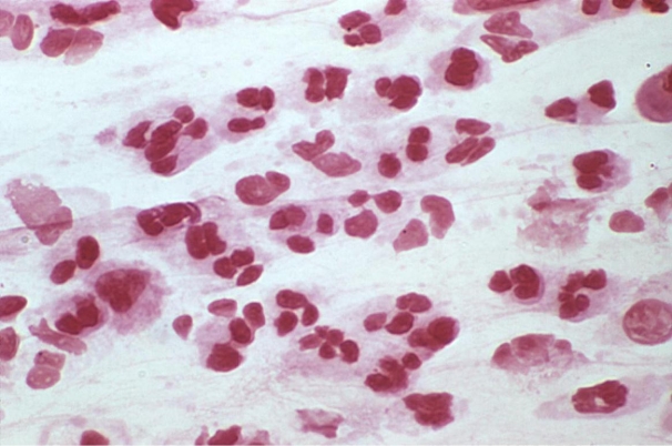 <strong>On a hot day in July, an unresponsive 15-year-old male presents with a stiff neck and fever. A cerebrospinal fluid is sent to the microbiology department for routine culture and Gram stain. The results of the direct Gram stain are provided. Source: CDC and Dr. Norman Jacobs Which of the following organisms can account for these Gram stain results?</strong> A) Neisseria meningitidis B) Mycobacterium tuberculosis C) Naegleria fowleri D) Herpes simplex virus