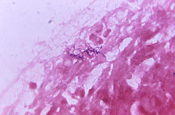 <strong>A 28-year-old male has had his wisdom teeth removed. Two weeks after the procedure, he develops swelling along the right jaw line in the area where his wisdom teeth were removed. His physician aspirates a pocket of pus within the jaw. The direct Gram stain of the aspirate is demonstrated in the image provided. Source: CDC This organism is known for the production of</strong> A) double beta hemolysis. B) dental caries. C) a Medusa head colony. D) sulfur granules.