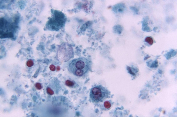 <strong>Review the image provided of a trichrome stained fecal specimen. Source: CDC How is the structure in the center of the image best distinguished from an amoeba?</strong> A) The image is an amoeba. B) The nuclear material: cytoplasm ratio is smaller in human cells. C) The nuclear material: cytoplasm is greater in human cells. D) White blood cells usually only have one nucleus.