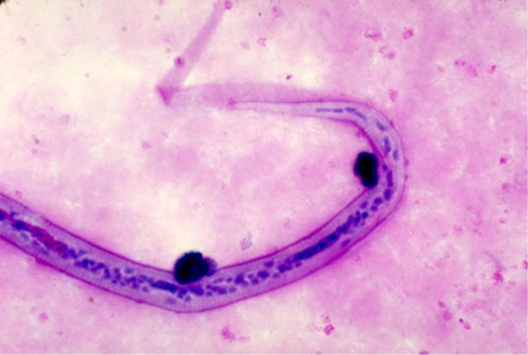 <strong>An astute hematologist notes the organism in the image provided on a stained blood smear. Source: CDC/Dr. Mae Melvin She calls you over to confirm its identification. She asks what disease is associated with this organism. You tell her</strong> A) river blindness. B) visceral larval migrans. C) elephantiasis. D) Calabar swellings.