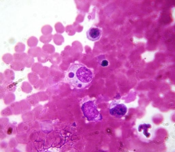 <strong>A 25-year-old male had been hiking in Southeast Missouri. He presented to his physician with headache, fever, and myalgia. He noted in his history many tick bites on his legs. The physician suspected Rocky Mountain spotted fever, but the serology proved to be negative and the patient did not have a rash. Routine culture of blood and bone marrow were negative. An observant medical laboratory scientist in the hematology department noted an unusual inclusion on the stain of the patient's bone marrow smear as seen in the image provided. Source: Filipe Dantas-Torres Based on this additional finding, the physician should now suspect</strong> A) Anaplasma phagocytophilum. B) Ehrlichia chaffeensis. C) Rickettsia rickettsii. D) Chlamydia trachomatis.