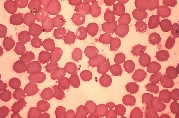 <strong>A set of blood culture bottles is drawn. At 48 hours, the anaerobic bottle is positive with the organism in the image provided. Source: CDC and Dr. Jack Poland You would subculture this positive blood culture bottle to 1) sheep blood agar. 2) chocolate agar. 3) MacConkey agar. 4) phenylethyl alcohol agar. 5) reducible blood agar</strong> A) 1, 2, 3, and 5 B) 2, 3, 4, and 5 C) 1, 3, 4, and 5 D) 1, 2, 3, and 4