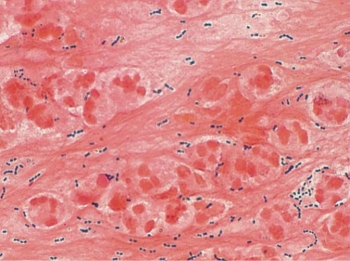 <strong>A 82-year-old female is hospitalized with pneumonia. The image provided is the direct Gram stain of her sputum. The sputum culture, after 48 hours incubation, reveals: Moderate growth of Enterobacter aerogenes Light growth of normal upper respiratory flora</UL> Based on all information obtained, you determine</strong> A) the results are accurate. B) the direct Gram stain slide was under-decolorized. C) there are discrepant results. D) this is a case of hospital-acquired pneumonia.