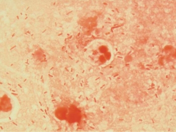 <strong>A comatose 28-year-old male was hospitalized three days ago due to head trauma after a motorcycle accident. He has been on a ventilator since admission. He has developed a fever. The physician orders blood, urine, and sputum cultures. The direct sputum Gram stain reveals the results noted in the image provided. The blood and urine cultures are negative at 48 hours. The sputum culture grows a predominance of Klebsiella pneumoniae with no normal upper respiratory flora present. This patient's infection Is probably due to</strong> A) aspiration pneumonia. B) ventilator-associated pneumonia. C) hospital-acquired pneumonia. D) all of the above.