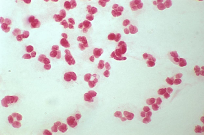 <strong>A pleural fluid is received in a capped syringe. A portion is centrifuged and the sediment is used to plate to sheep blood, chocolate, and MacConkey agars as well as a thioglycolate broth. The direct Gram stain results are demonstrated in the image provided Source: CDC and Dr. Norman Jacobs At 24 hours, 2 colonies of a white, gamma-hemolytic colony were present on the sheep Blood agar. The organism is a catalase-positive, Staphylococcus latex Agglutination- negative, gram-positive coccus. The organism proved to be oxacillin Resistant on susceptibility testing. Based on these results, you</strong> A) report very light growth Staphylococcus aureus. B) report very light growth Staphylococcus not S. aureus. C) complete a variance report because a reducible blood agar should have been added initially. D) a and c. E) b and c.