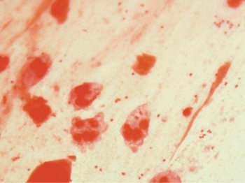 <strong>A 92-year-old male is hospitalized with community-acquired pneumonia. The image provided is the direct Gram stain of his sputum. The sputum culture, after 48 hours incubation, reveals: Moderate growth of small hockey puck colonies that produce a blue-green Butyrate esterase result Light growth of normal upper respiratory flora Based on all information obtained, you report moderate growth of</strong> A) normal upper respiratory flora. B) Moraxella catarrhalis. C) Neisseria meningitidis. D) Neisseria gonorrhoeae.