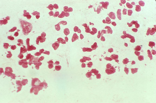 <strong>Catheterized urine from a 49-year-old female was submitted for Gram stain and culture. The image provided demonstrates the Gram stain of one drop of the urine at 1000X magnification. Source: CDC and Dr. Normal Jacobs Determine the expected bacterial colony count based on these results.</strong> A) >10<sup>2</sup> CFU/mL but <10<sup>5</sup> CFU/mL B) >1000 organisms/mL but < 100,000 organisms/mL C) >10<sup>5</sup> CFU/mL D) 10,000 - 50,000 organisms/mL