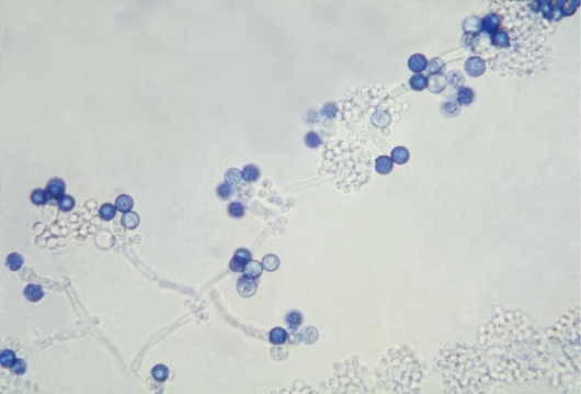 <strong>Thirty colonies of a white creamy isolate were noted at 24 hours on the sheep blood agar of a catheterized urine culture from a 53-year-old male hospitalized for a ruptured appendix. The MacConkey agar showed no growth. The agars were inoculated using a 0.01 mL calibrated loop. On further testing, the white colony produced the results observed in the image provided. Source: CDC/Dr. Godon Roberstad This organism should be reported as</strong> A) 300 colonies/mL of yeast not Candida albicans. B) 300 colonies/mL of Candida glabrata. C) 3000 colonies/mL of Candida glabrata. D) 3000 colonies/mL of Candida albicans.