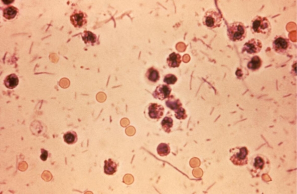 <strong>Based on the Gram stain image of a fecal specimen provided, determine the probable pathogenic mechanism responsible if the diarrhea present is due to an enteric bacterial pathogen. Source: CDC</strong> A) Enterotoxin production B) Cytotoxin production C) Neurotoxin production D) Adherence