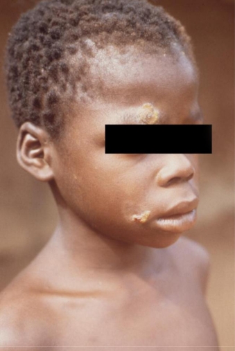 <strong>A 10-year-old male from Africa presents with skin lesions as seen in the image provided. Source: CDC and Dr. Peter Perine The lesions demonstrate spirochetes on darkfield examination. The treponemal Serologic tests are also positive. You suspect the infection is due to</strong> A) Treponema pallidum ssp. pallidum. B) T. pallidum ssp. endemicum. C) T. carateum. D) T. pallidum ssp. pertenue.