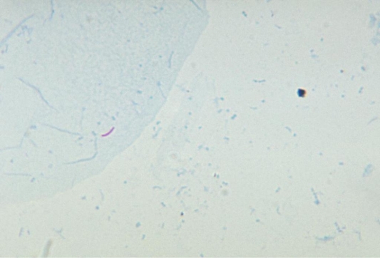 <strong>Using the image provided and knowing the primary stain used was not heated after application, one can determine this slide depicts a Source: CDC and Ronald W. Smithwick</strong> A) positive Kinyoun reaction. B) positive Ziehl-Neelsen reaction. C) negative Kinyoun reaction. D) negative Ziehl-Neelsen reaction.