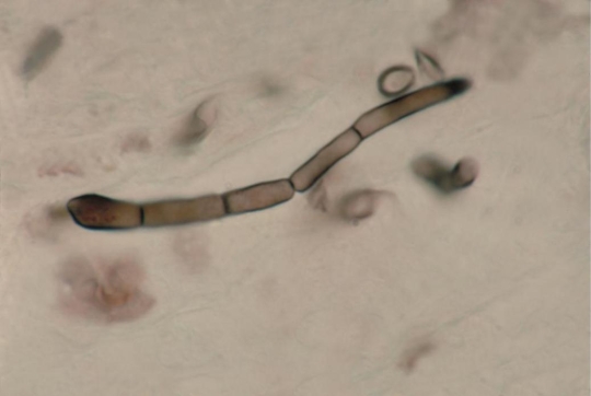 <strong>Using the image provided, the fungal element observed is described as Source: CDC and Dr. Libero Ajello</strong> A) a germ tube. B) dematiaceous septate hyphae. C) hyaline aseptate hyphae. D) conidiophores.