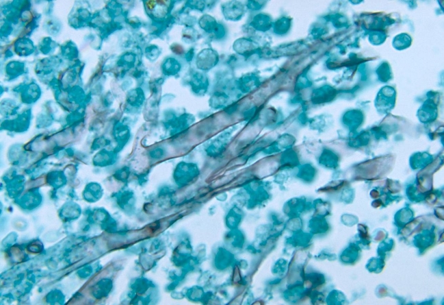 <strong>Using the image provided, the fungal element observed is described as Source: CDC and Dr. Libero Ajello</strong> A) hyaline septate hyphae. B) hyaline aseptate hyphae. C) dematiacous septate hyphae. D) dematiaceous aseptate pseudohyphae.